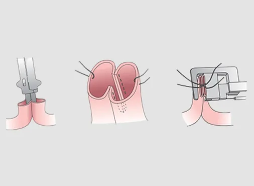 Small Bowel Surgery - Laparoscopic Resection and Anastomosis consultation at Niraaya Hospital